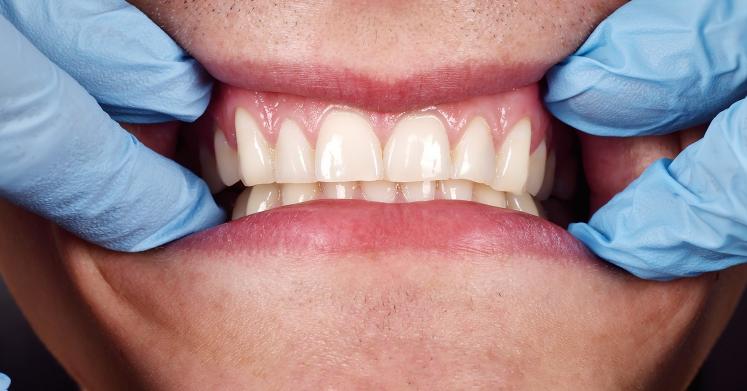 Periodontal Disease